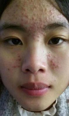 额头和脸上长痘痘怎么办