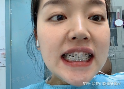 牙齿微龅如何矫正