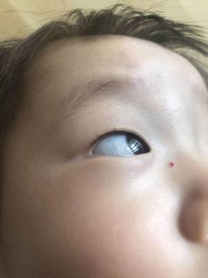 小孩脸上长小红点是怎么回事
