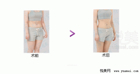肚子抽脂安全吗