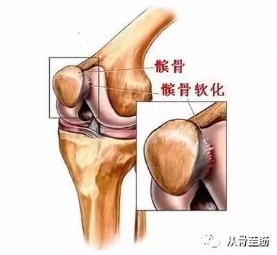 髌骨关节炎怎么治疗