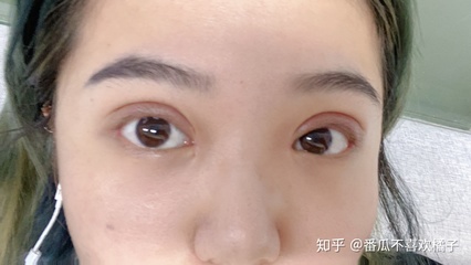 右眼皮肿是怎么回事