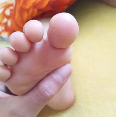 脚底湿疹怎么治疗