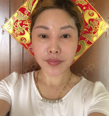 悬吊除皱v美减龄实力