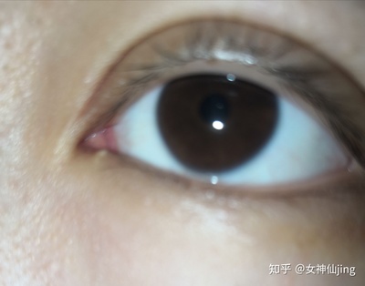 双眼皮上长了个脂肪粒