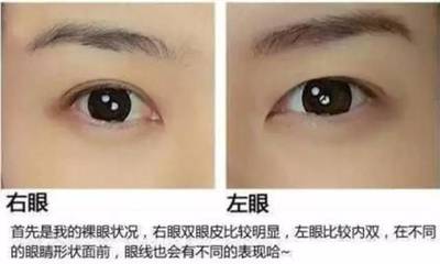 割双眼皮眉毛离眼睛近
