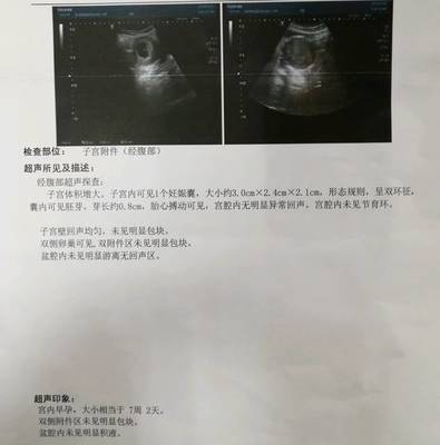 怀孕7周有胎心胎芽吗
