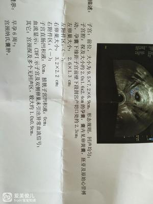 宫颈纳氏囊肿会影响怀孕吗