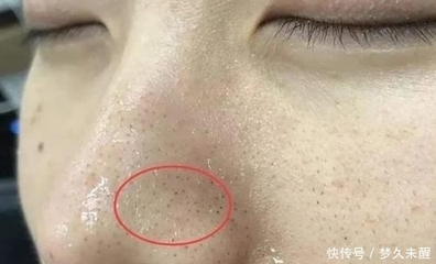毛孔有白色条状物