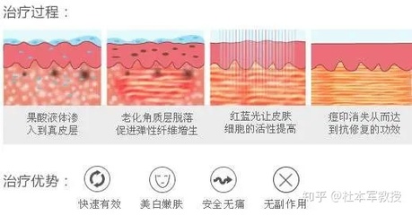 红蓝光祛痘副作用