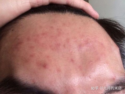 男生皮肤多痘痘痘印