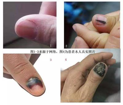 灰指甲初期怎么治疗