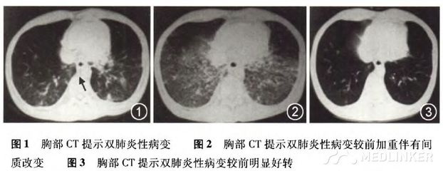颈部淋巴结核怎么治疗