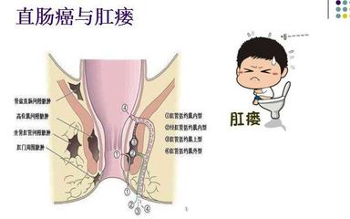 肛窦炎怎么治疗