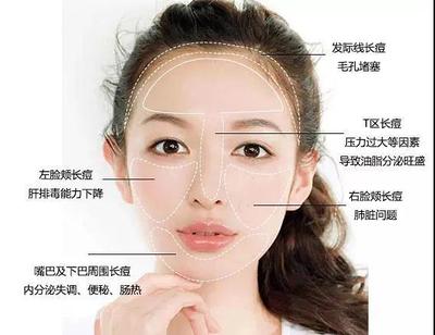 脸颊长闭口痘痘的原因分析