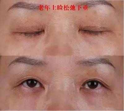 天生三眼皮