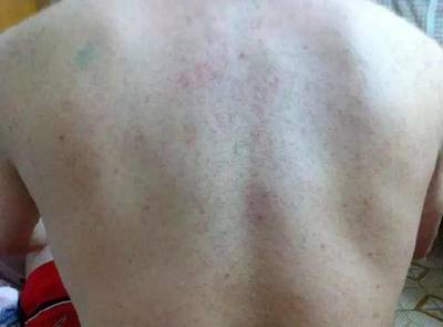 热气导致的痘痘怎么消