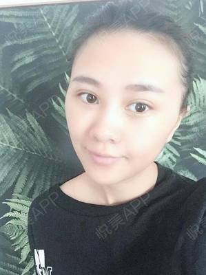 玻尿酸打泪沟几天消肿