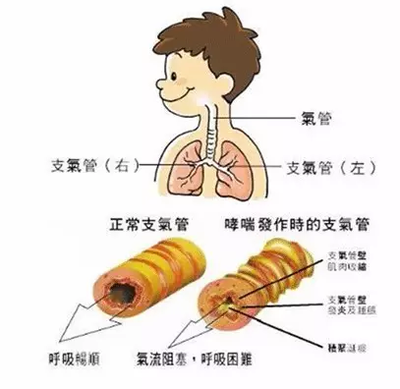 咳泡沫痰是怎么回事