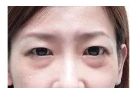 眼袋大是怎么回事