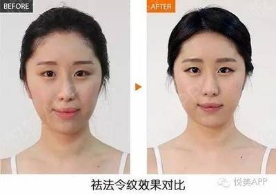 法令纹是