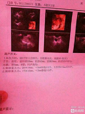 双侧卵巢多囊会怀孕吗