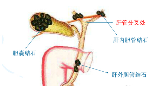 肝管结石怎么治疗最好的方法