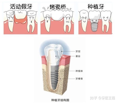 种牙的材料