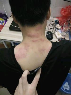 臭虫咬了怎么治疗