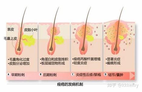 男生经常长痘痘要去角质吗