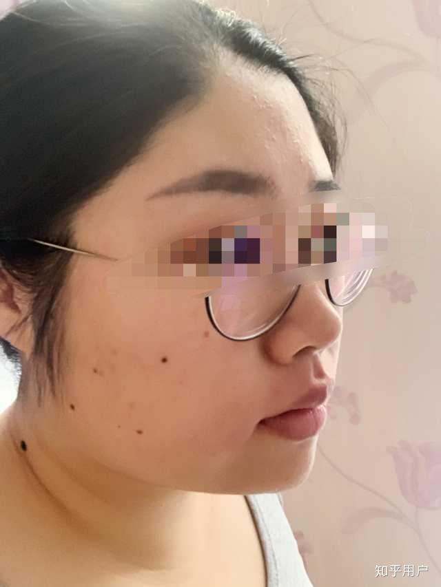 长痘痘能脱唇毛