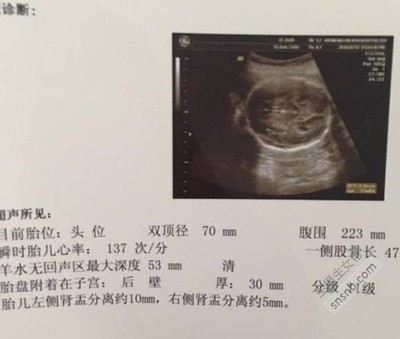胎儿肾盂扩张是男孩吗
