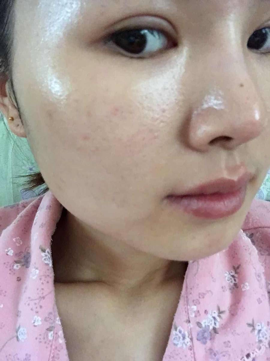 资深痘痘