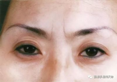 眉间纹的面相图解