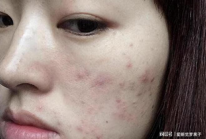 脸色起痘痘怎么排毒