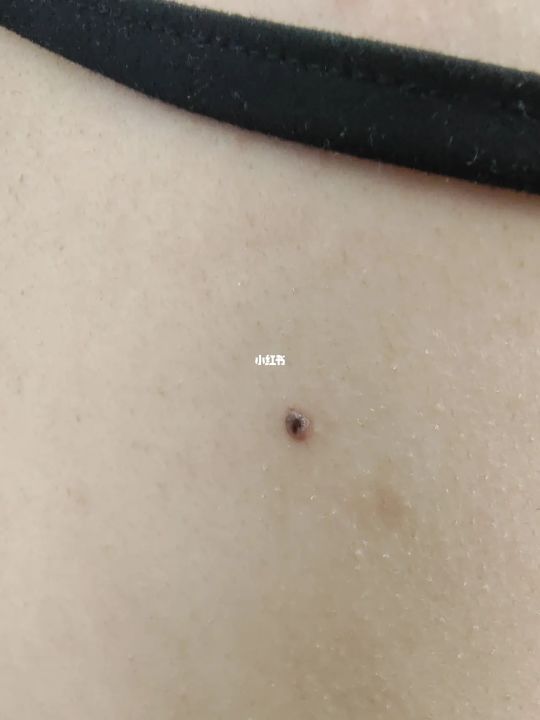 背上的痘痘是啥