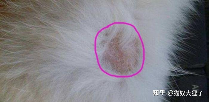 人长猫癣怎么治疗