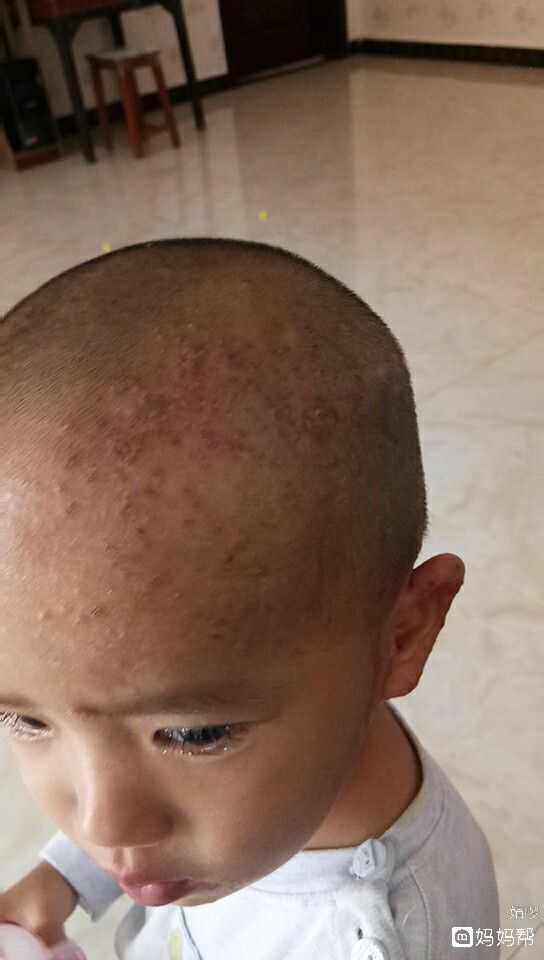 头上爱长痘痘
