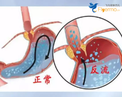 胃烧心怎么治疗