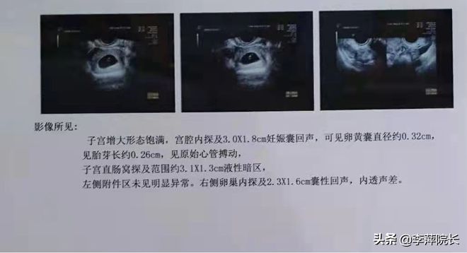 怀孕一个月小腹坠胀
