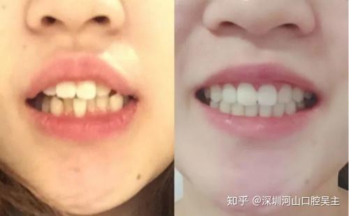三十岁矫正牙齿要多久