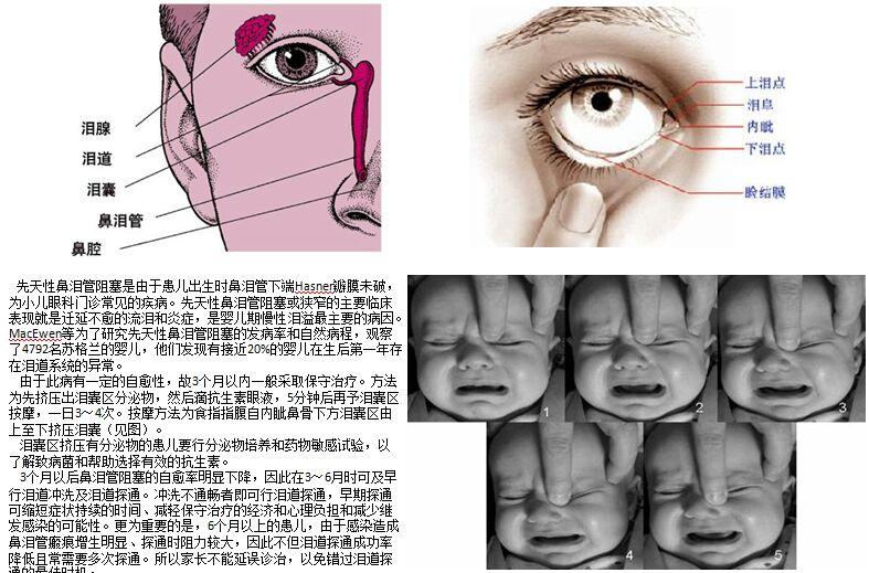 新生儿泪道堵塞的症状