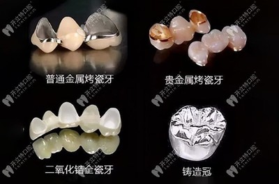 镶一个烤瓷牙多少钱