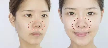 产后脸上长痘痘用什么药