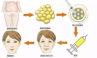 脸部填充脂肪的副作用