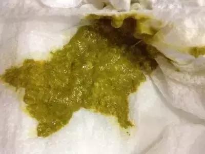 宝宝粑粑里有黑色颗粒