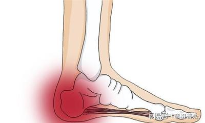 脚后跟疼是怎么回事儿