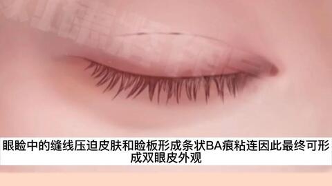 曲靖埋线双眼皮