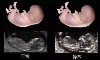 胎儿胎位什么时候固定