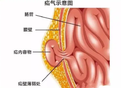 中医疝气怎么治疗